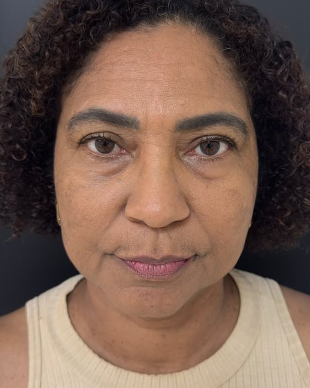 Caso 1, antes do preenchimento full face