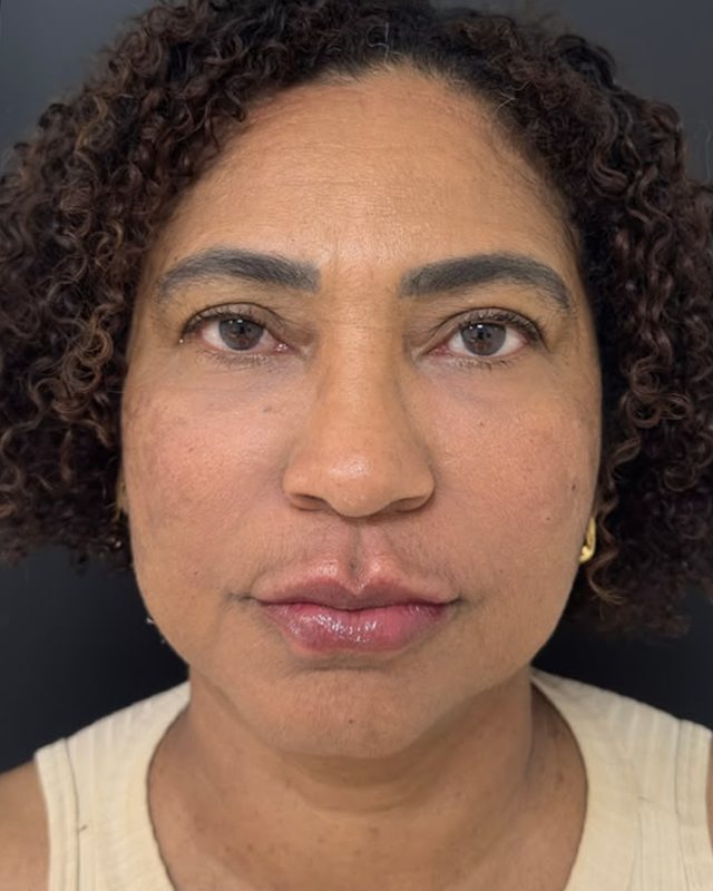 Caso 1, depois do preenchimento full face