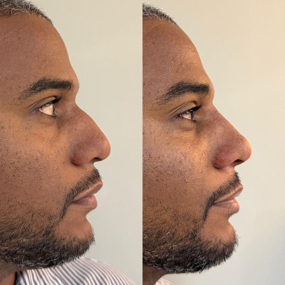Registro de resultado de perfiloplastia realizada por Andréa Chaves