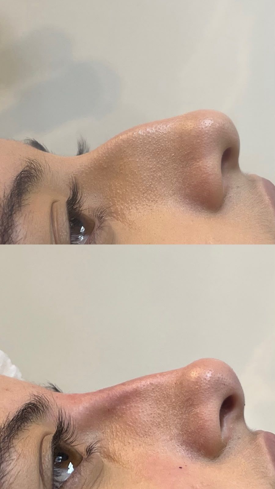 Registro de resultado de perfiloplastia realizada por Andréa Chaves