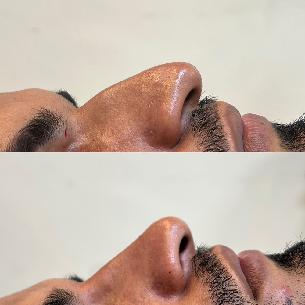 Registro de resultado de perfiloplastia realizada por Andréa Chaves