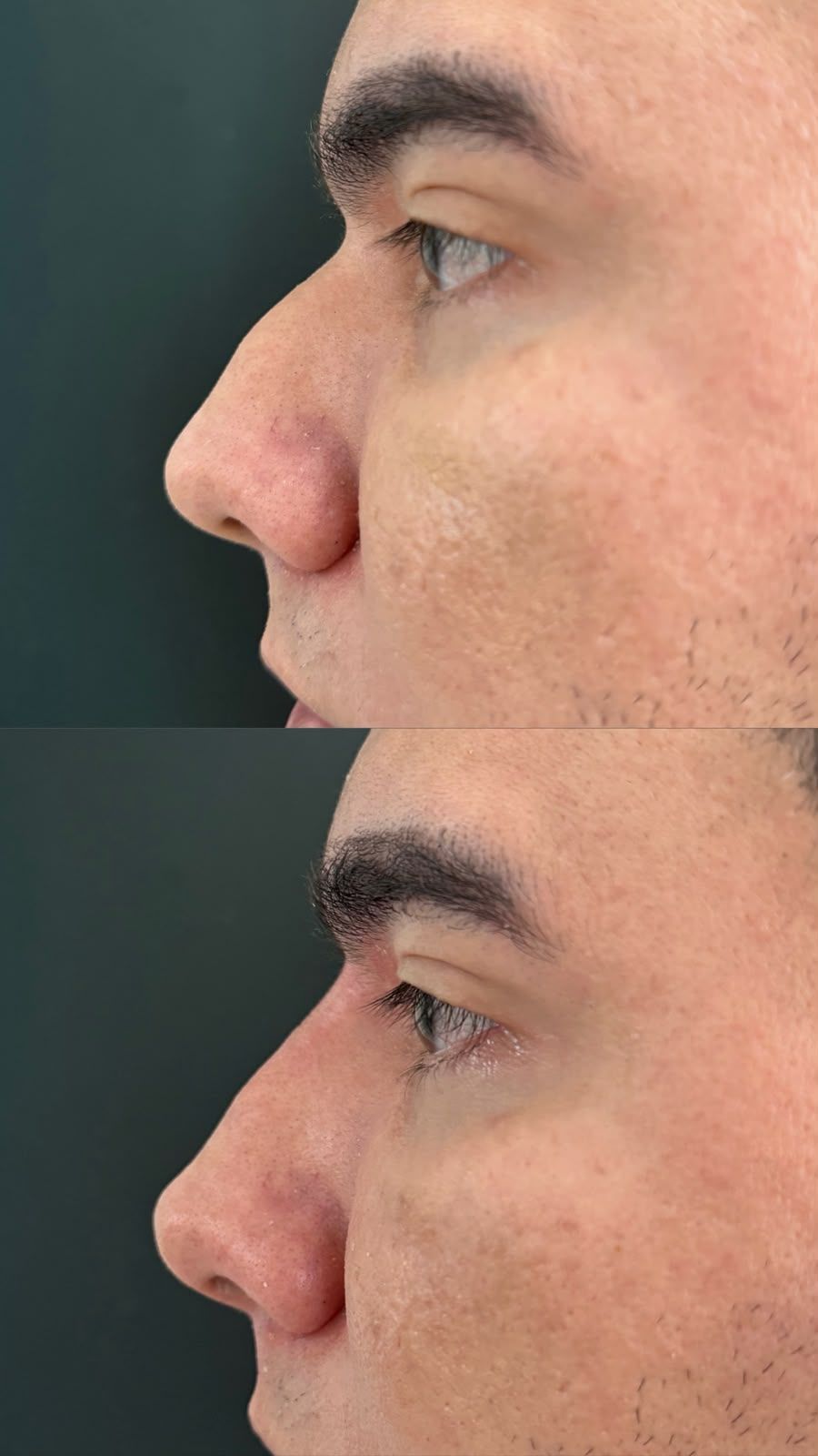 Registro de resultado de perfiloplastia realizada por Andréa Chaves