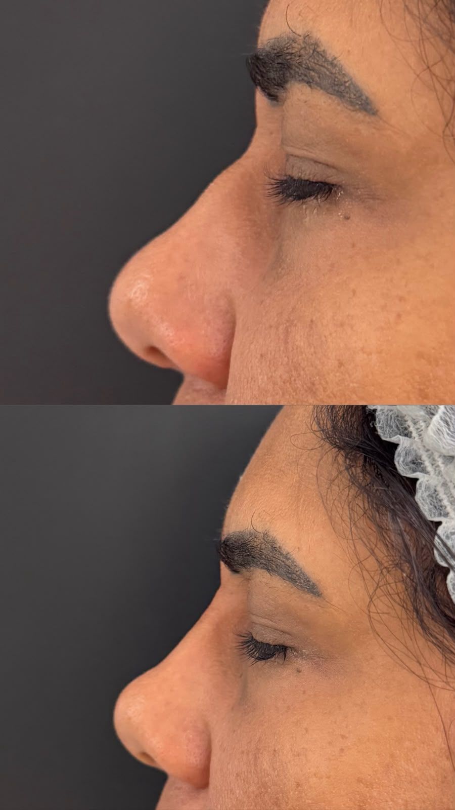 Registro de resultado de perfiloplastia realizada por Andréa Chaves