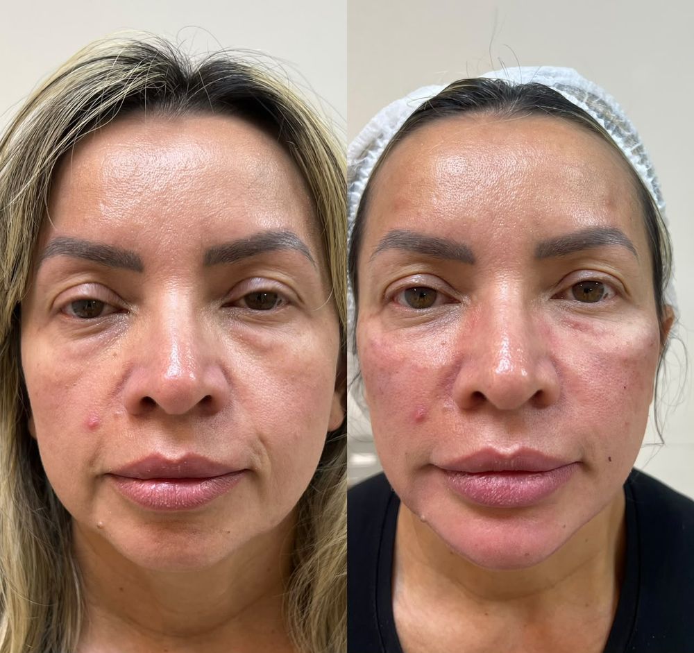 Registro de resultado de preenchimento full face realizado por Andréa Chaves