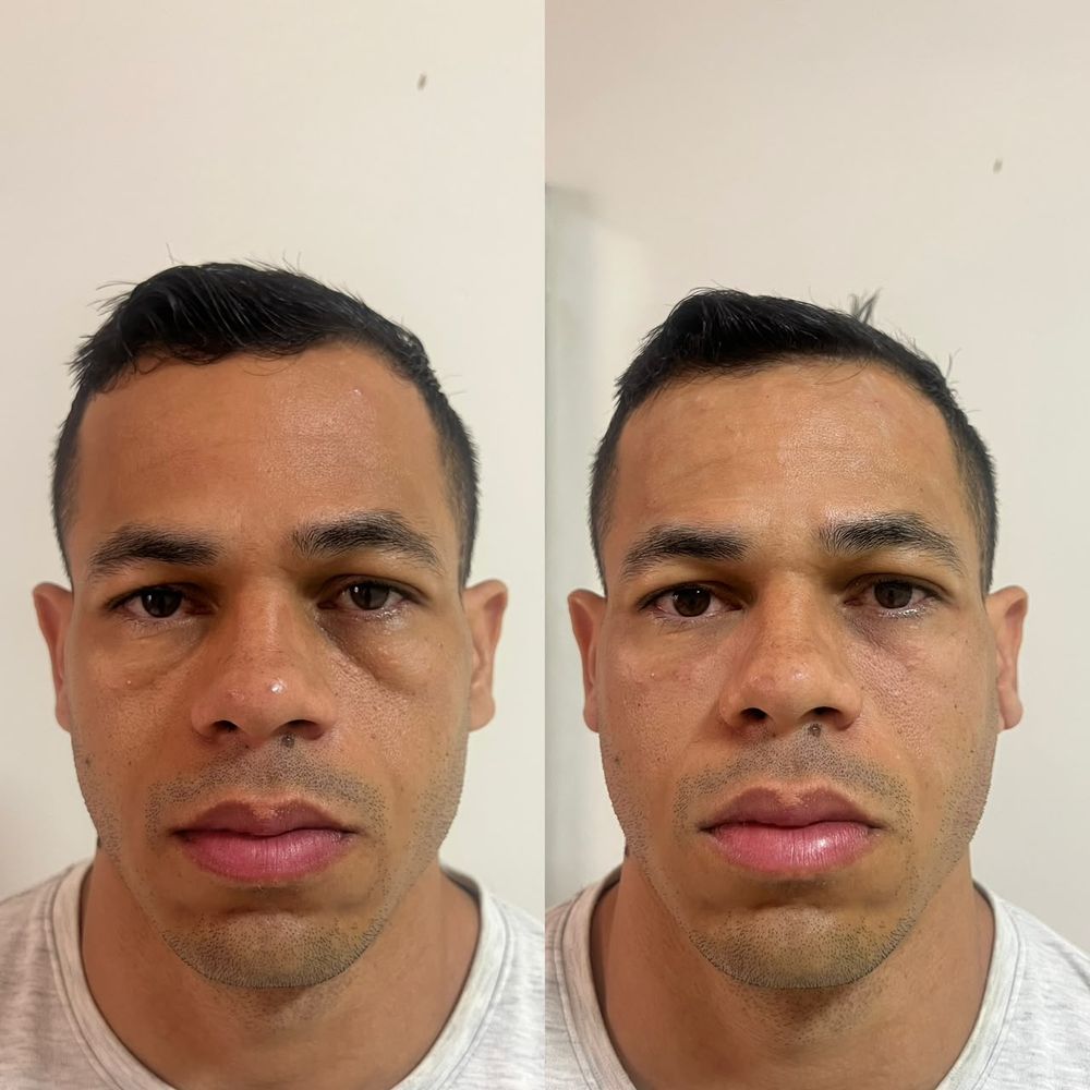 Registro de resultado de preenchimento full face realizado por Andréa Chaves